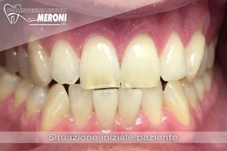 SItuazione iniziale paziente prima dello sbiancamento eseguito al Polispecialistico Meroni di Cantù